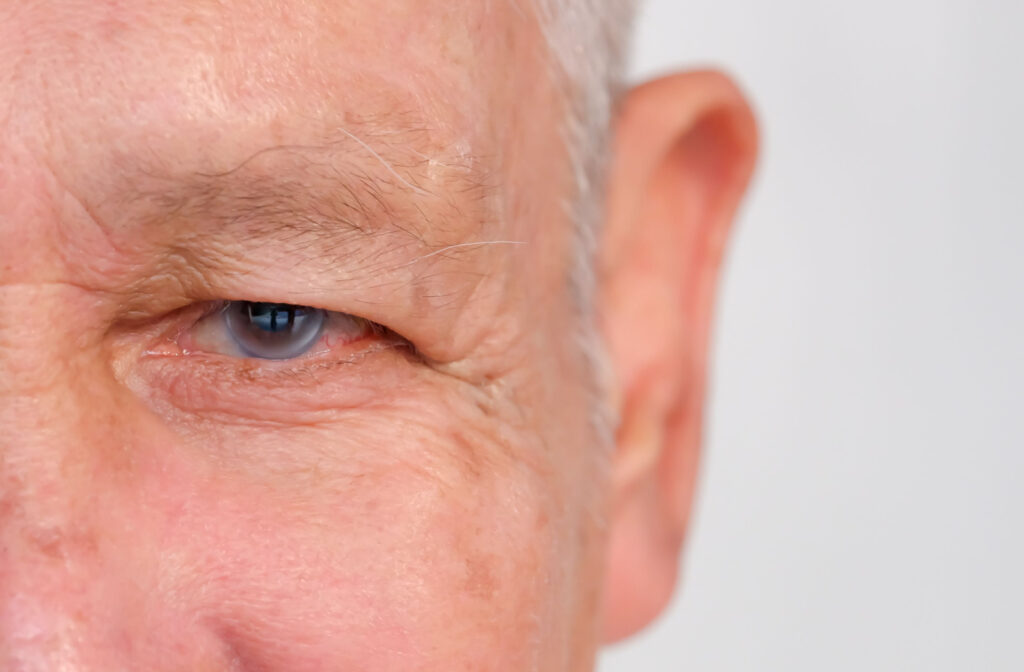 A close-up of a senior man's left eye with signs of glaucoma.