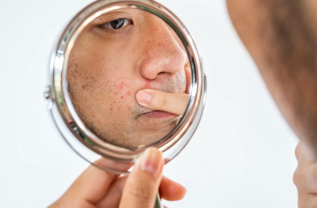 Mirror shot of a man pointing at several acne scars on his cheek between the corner of his mouth and his nose