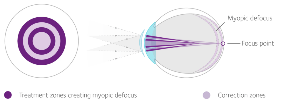 Diagram illustrating myopia control using a specialized contact lens, showing concentric treatment zones that create myopic defocus and focus light in front of the retina to slow eye growth.